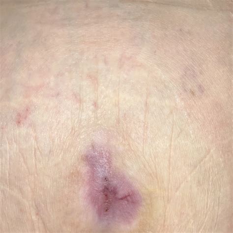 Wound Care Success Stories: Before and After | Jovive Wound Care