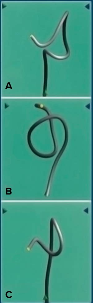 Image result for Colonoscopy Loop