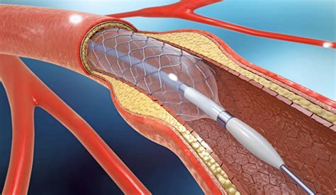 Scientists use '4D printing' to develop the world’s smallest stent ...