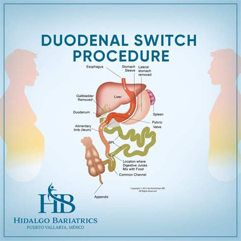 Transform Your Health: Duodenal Switch Surgery in Sunny Puerto Vallarta