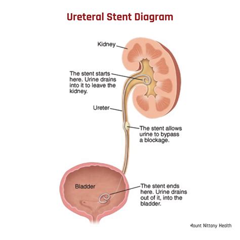 Stent In Ureter