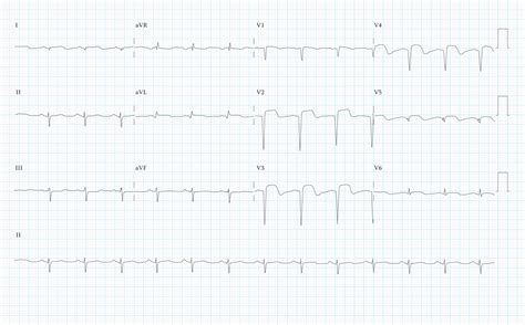12 Lead ECG Practice Exercise - SkillStat