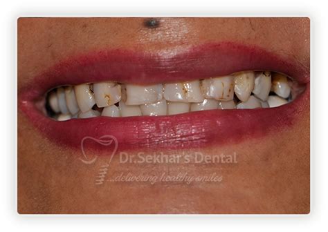 Best Dental Veneers in Hyderabad India | Dental Veneers Cost