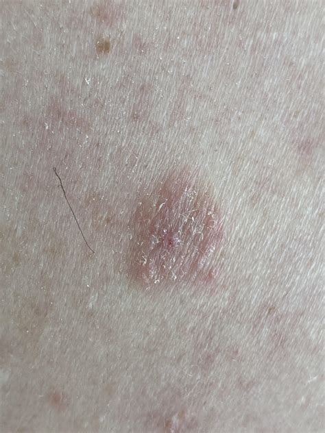 I got this itchy patch on my back. Have already had stage 1 melanoma removed from my arm a year ...