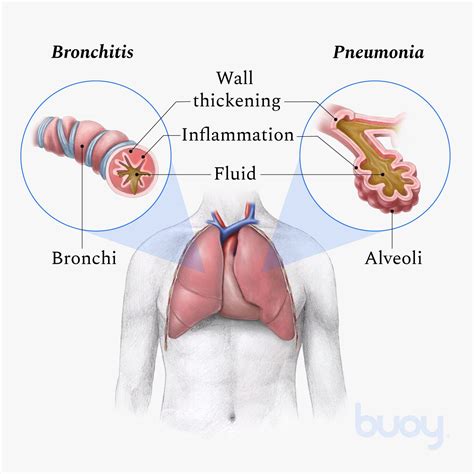 Chest X Ray Bronchitis Vs Pneumonia