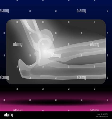 Fracture X Ray Of Bone at Joseph Sabala blog