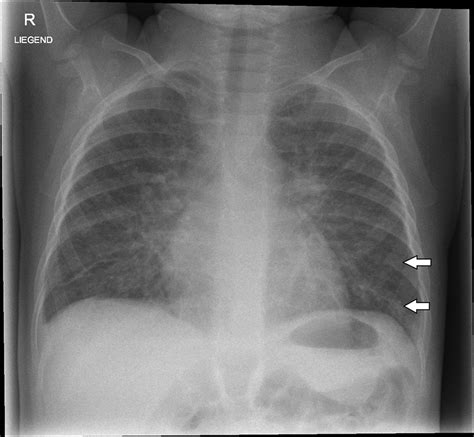 Kerley B Lines Pulmonary Edema