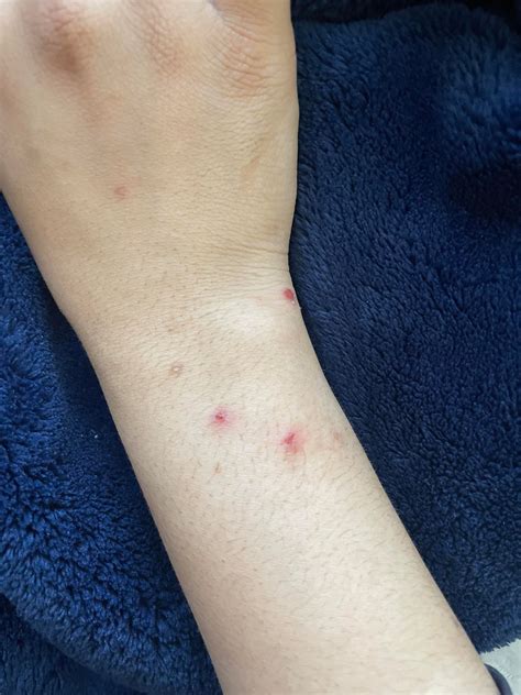 bug bite scabs/scars : r/bugbites