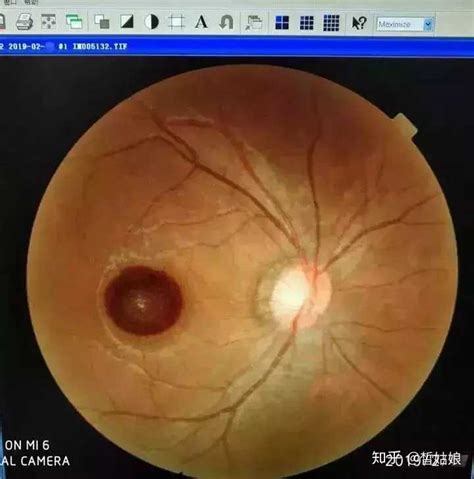 【深圳】9岁孩子视力突然降至0.5，医生；激光笔照射损坏导致视网膜病变_视网膜_医生_视力