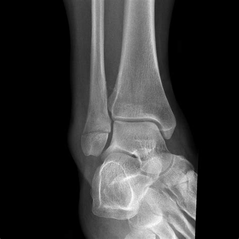 Lateral Malleolus Fracture