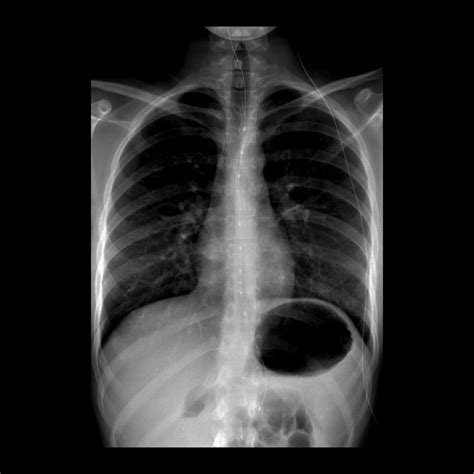 Teenager with symptoms of gastroesophageal reflux | Pediatric Radiology ...