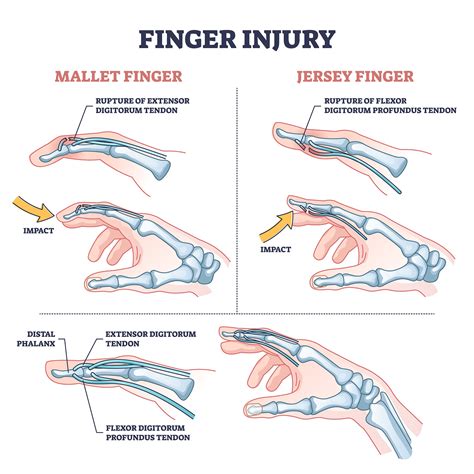 Mallet Finger Healing Process