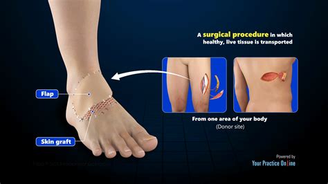 FLAP Foot Reconstruction Video | Medical Video Library