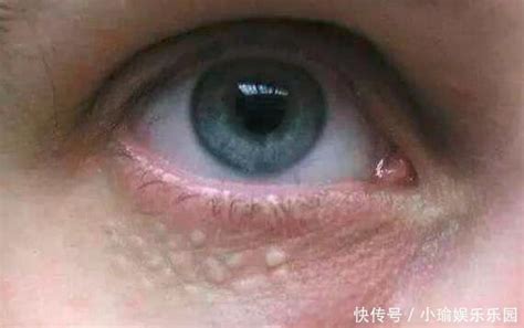 【图】眼睛周边长脂肪粒怎么治疗 3种去除方法介绍_眼睛 脂肪粒_伊秀美容网|yxlady.com