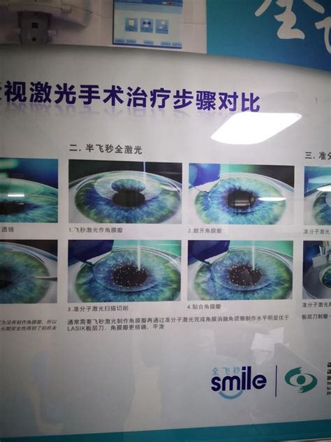 全飞秒Smile近视手术前准备及术中注意事项 - 南阳尖峰眼科医院有限公司