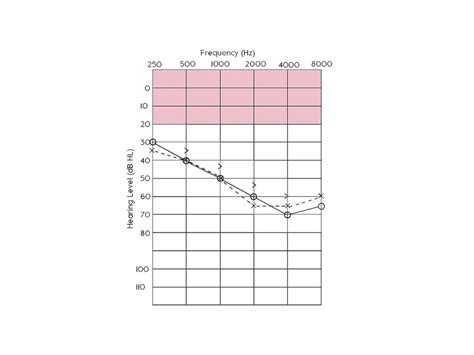 Audiogram Types and examples 的图像结果