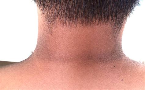 Black Neck: 10 Amazing Ways To Get Rid Of It – SkinKraft
