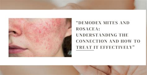 Demodex Mites Rosacea May Be Caused By Mite Faeces In Your Pores | New