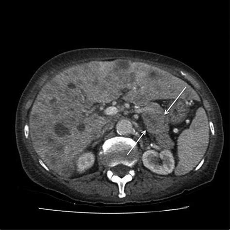 Sister Mary Joseph nodule | BMJ Case Reports