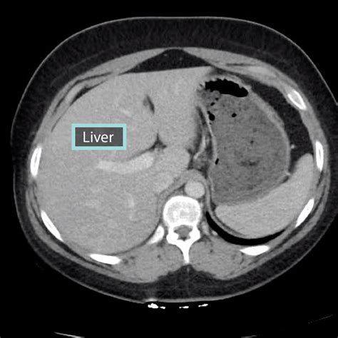 Liver On Ct