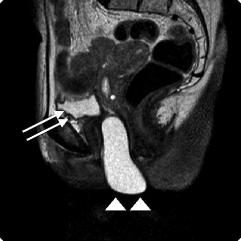 Gartners Duct Cyst Ultrasound