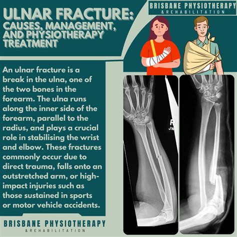 Fractured Ulna And Radius Bones