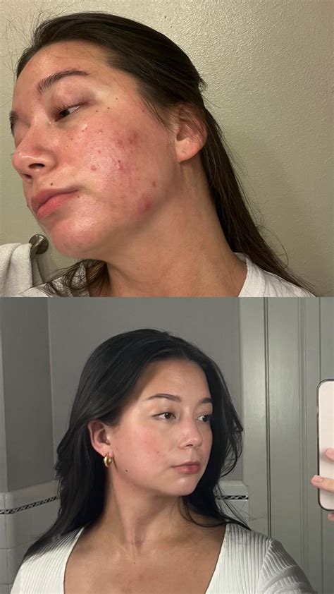 month 1 vs month 7, one more to go! (40/60/80/80/80/80/80) : r/Accutane