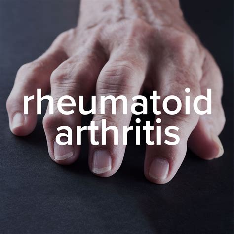 Natural Remedies for Arthritis For A Safer Alternative | Rheumatoid ...