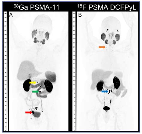 A Treatment Paradigm Shift: Targeted Radionuclide Therapies for ...