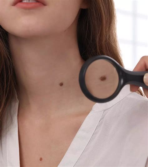 Skin Tags During Pregnancy: What You Need To Know