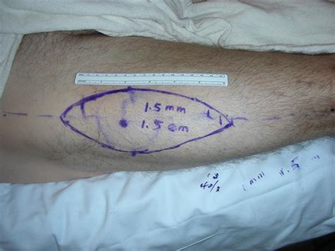 Leg Reconstruction: Distal Third (Free Flaps) - Clinical Tree