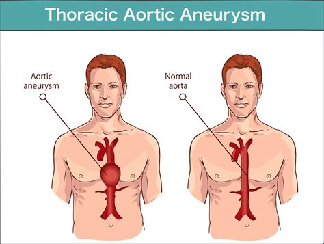 Thoracic Aortic Aneurysm Repair