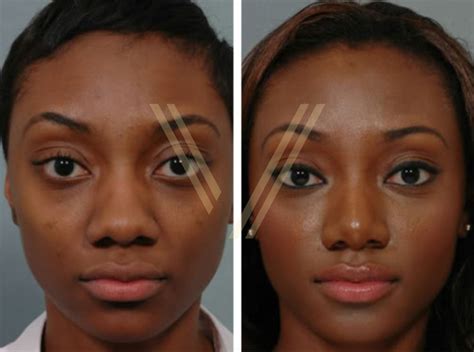 Black Rhinoplasty Before And After