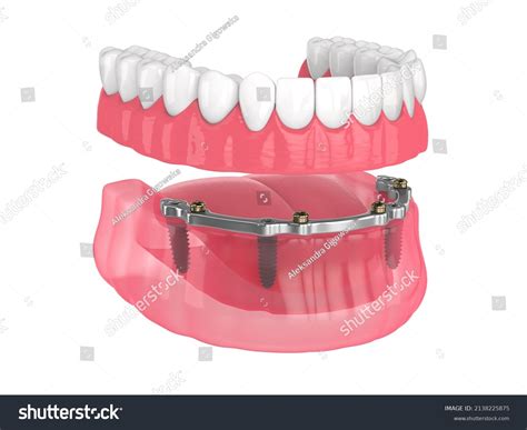 480 Implant Retained Dentures Images, Stock Photos & Vectors | Shutterstock