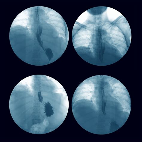 Image result for Contrast Fluoroscopy