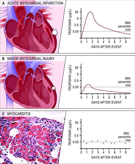 Cardiac Troponin Assays | Circulation