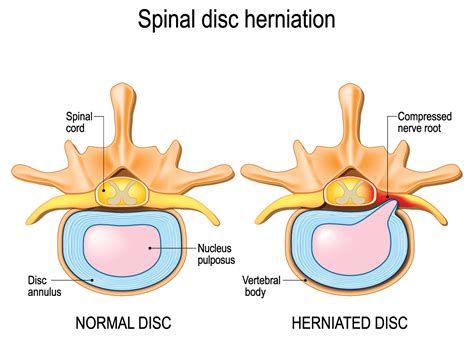 Normal vs herniated disc diagram