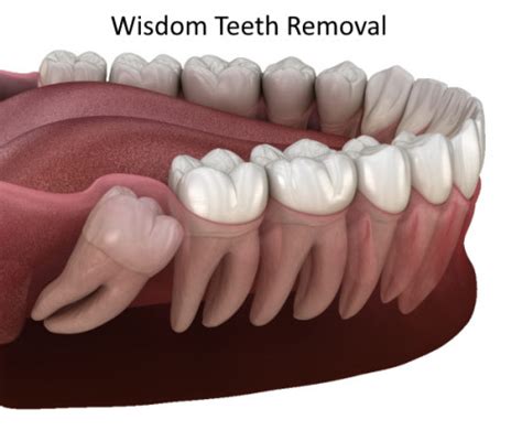 Image result for Remove Wisdom Teeth