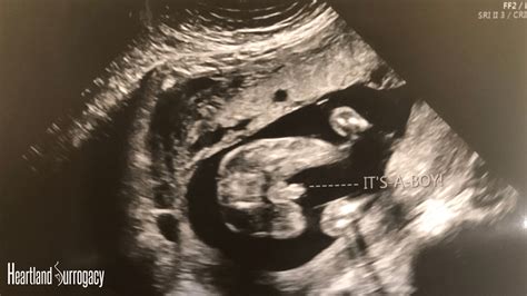 What Is Anatomy Ultrasound Coronal Ultrasound Anatomy Of A Normal Hip