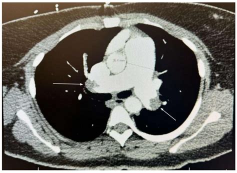 Extensive Bilateral Pulmonary Embolism Secondary to Uterine Fibroid ...