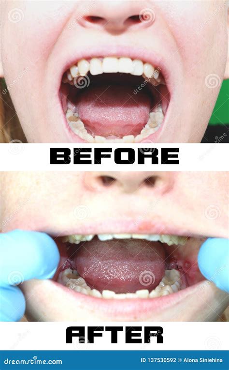Before and after the Operation To Remove Wisdom Teeth - Eights. Close-up of Wisdom Teeth and ...