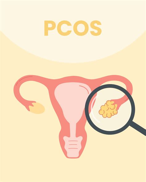 Overview of polycystic ovarian syndrome