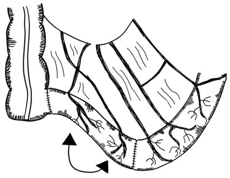 Surgical Treatment of Short Bowel Syndrome—The Past, the Present and ...