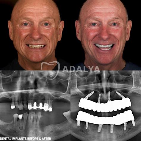 Dental Implants Before and After: Pictures & All Guideline