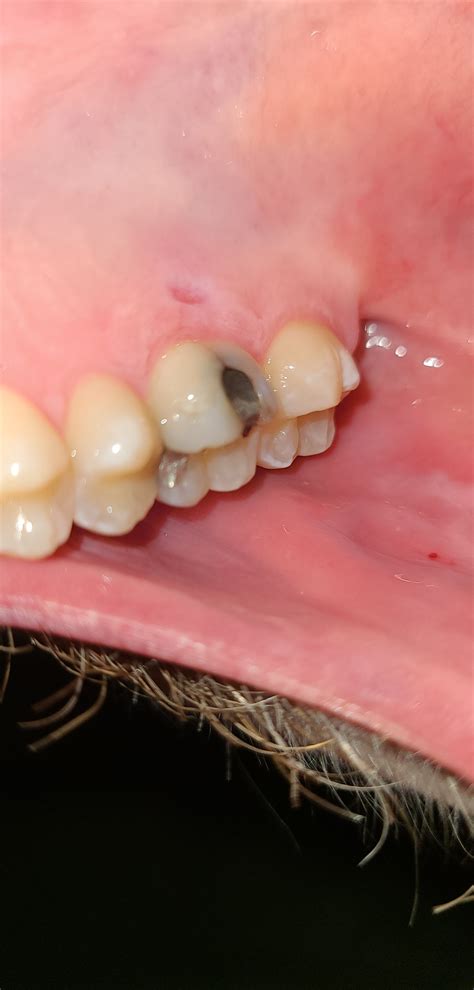 Image result for Tooth Hole