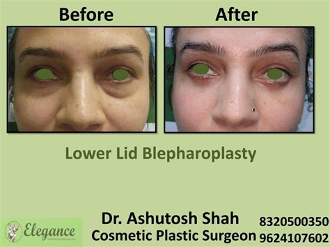 Lower Lid Bleapharoplasty, Eliminating Lower Eyelid Puffiness, Best ...