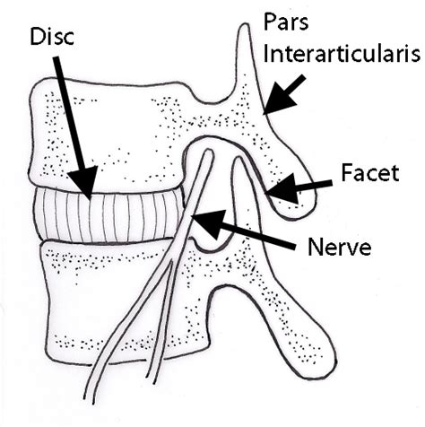 Kuvatulokset haulle pars fracture treatment