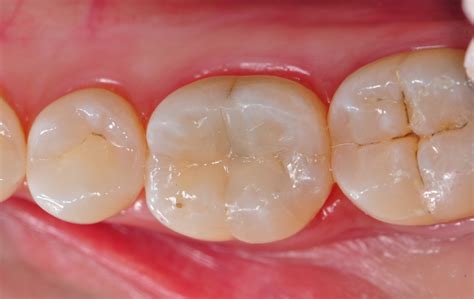 Usluge | Kompozitni ispuni | Daniela dental Split