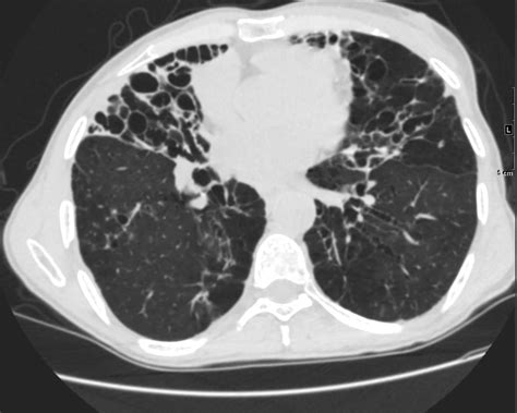 Lung Fx Bronchiectasis Dx Lady Windermere syndrome Infection 61-year-old male with a history of ...