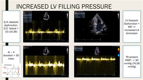Hypertrophy Obstructive Cardiomyopathy.pptx
